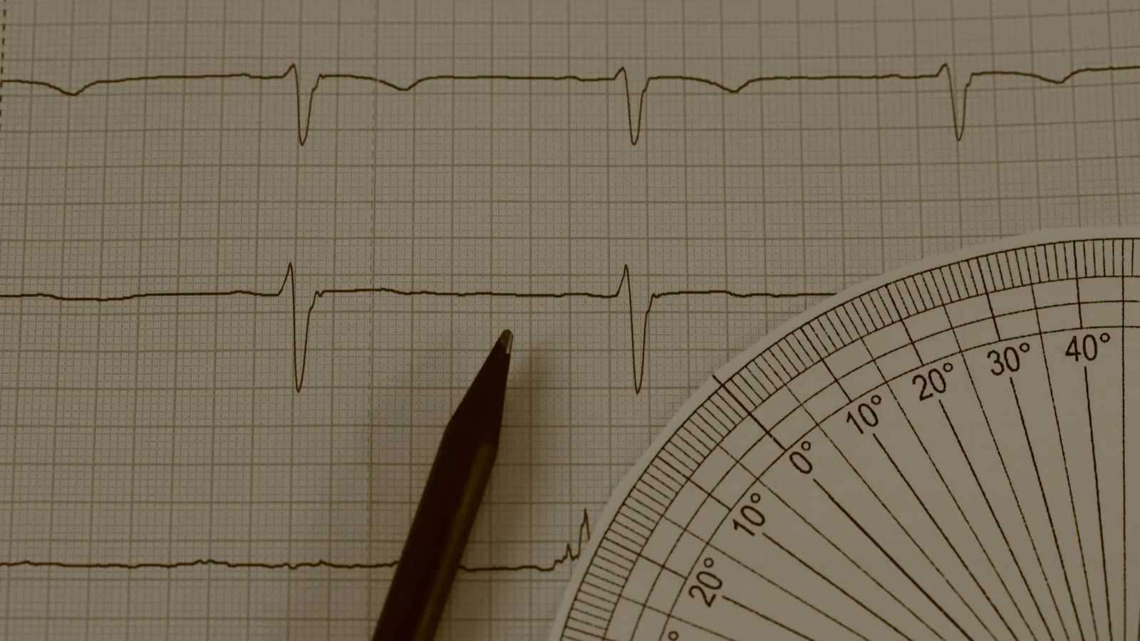 Fibrilação Atrial: Sintomas, Risco de AVC e Acompanhamento
